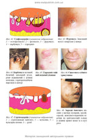 Dermatology and Venereology: textbook / V.I. Stepanenko, A.I. Chobotar, S.O. Bondar et al. — 2nd edition