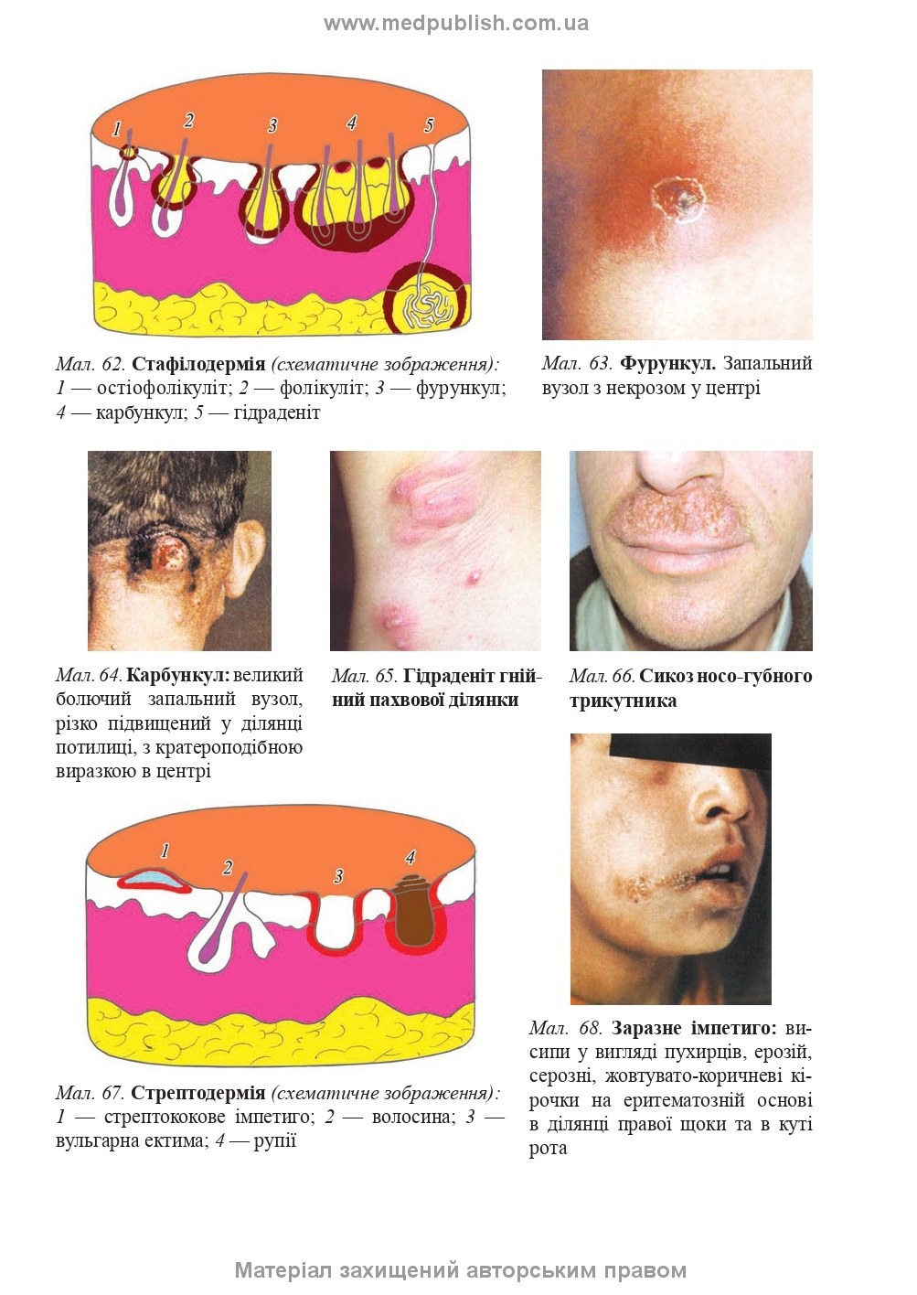 Dermatology and Venereology: textbook / V.I. Stepanenko, A.I. Chobotar, S.O. Bondar et al. — 2nd edition