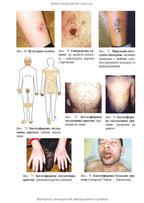 Dermatology and Venereology: textbook / V.I. Stepanenko, A.I. Chobotar, S.O. Bondar et al. — 2nd edition