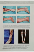 Perforator Flaps in Reconstructive Surgery / Sliesarenko S.V., Badiul P.O.