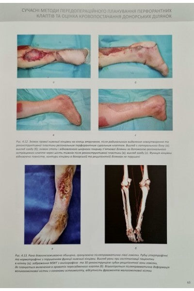 Perforator Flaps in Reconstructive Surgery / Sliesarenko S.V., Badiul P.O.