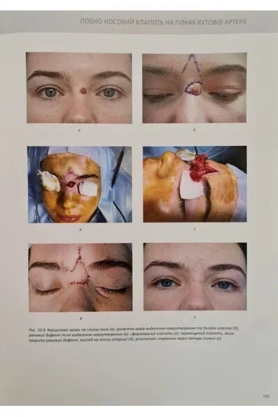 Perforator Flaps in Reconstructive Surgery / Sliesarenko S.V., Badiul P.O.