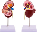 Kidney model with pathologies