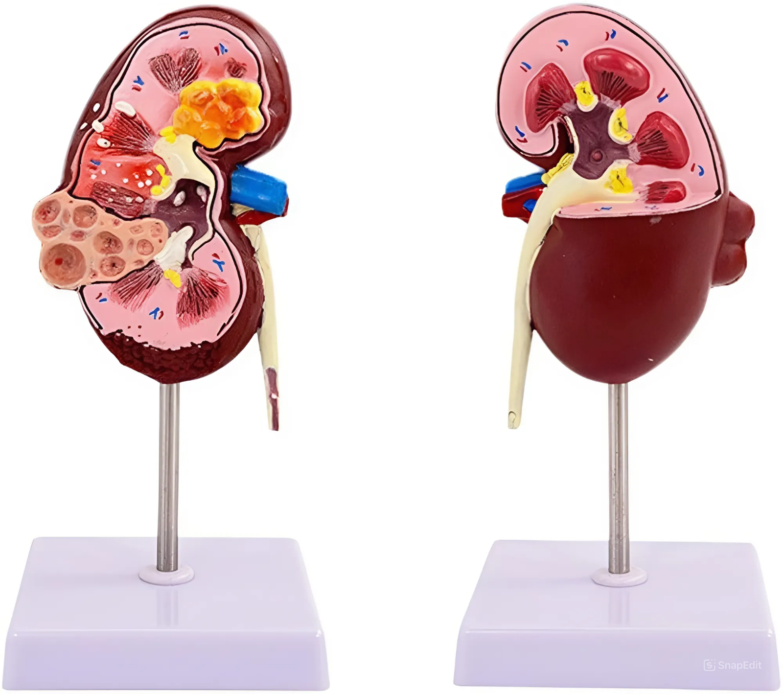 Kidney model with pathologies