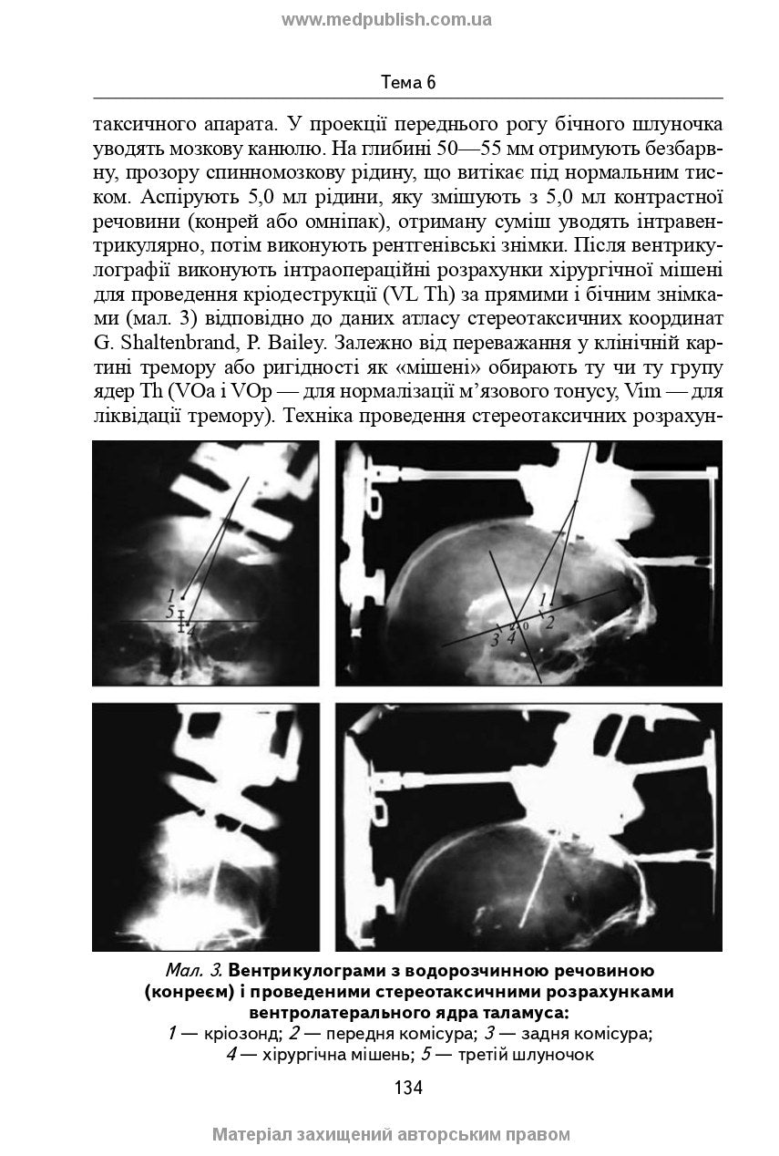 Neurosurgery: a textbook / V.O. Piatykop, I.O. Kutovyi, A.V. Kozachenko et al.