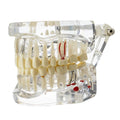 Dentures
